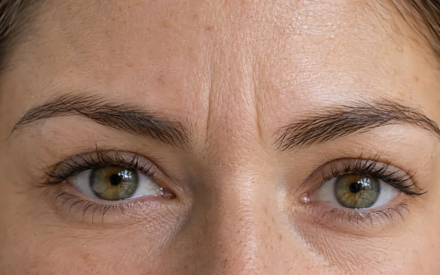Frown lines, shown on the face