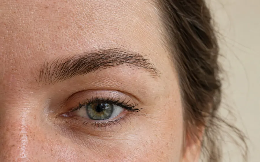 Low or heavy brows, shown on the face
