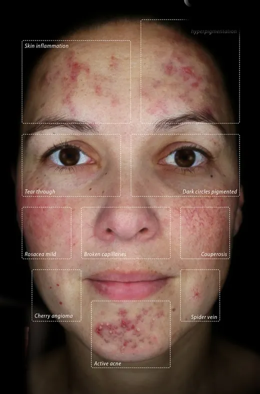 Skin photographed in the Observ 520x Cross polarised mode, with the features the mode reveals marked