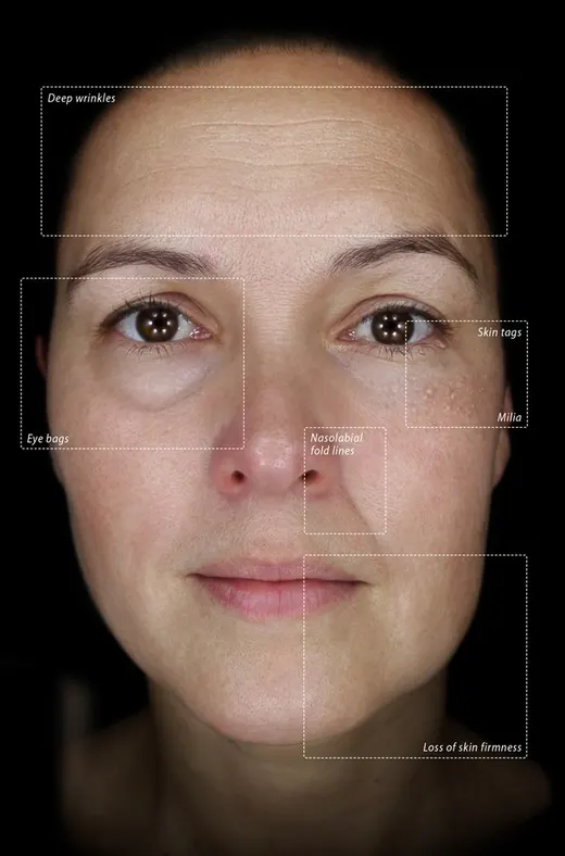 Skin photographed in the Observ 520x Daylight mode, with the features the mode reveals marked