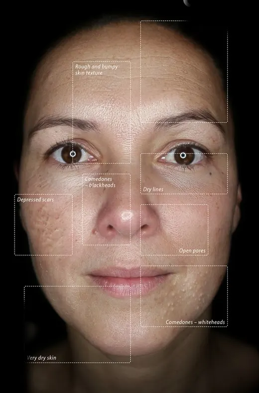 Skin photographed in the Observ 520x Parallel polarised mode, with the features the mode reveals marked