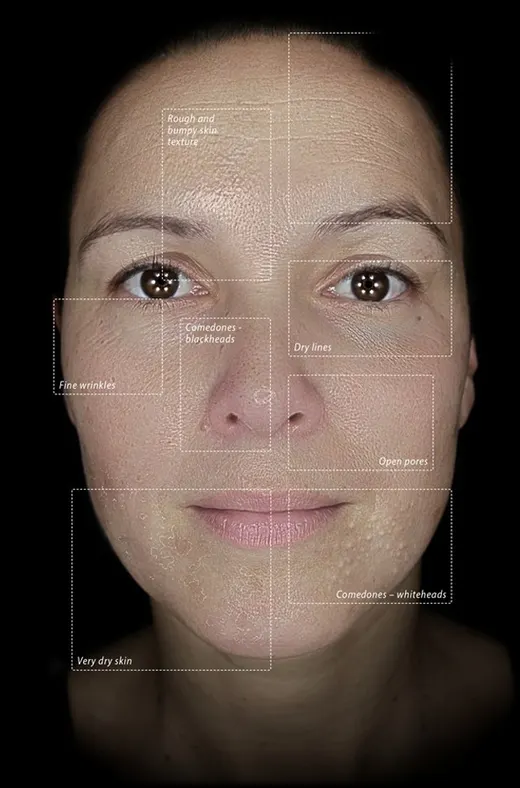 Skin photographed in the Observ 520x Pigmentation mode, with the features the mode reveals marked