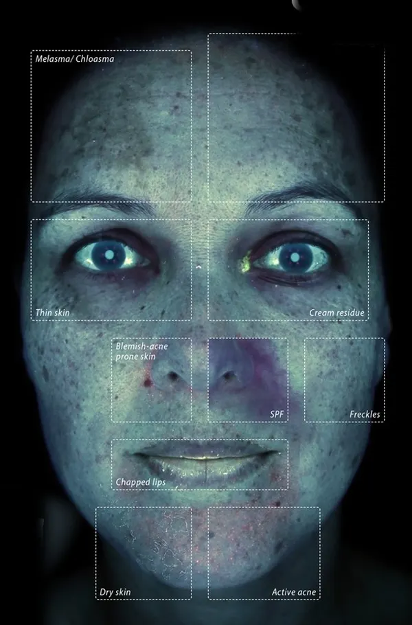 The same face in the Observ 520x True UV mode, with sun damage, pigment and congestion fluorescing