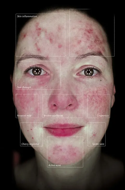 Skin photographed in the Observ 520x Vascularity mode, with the features the mode reveals marked