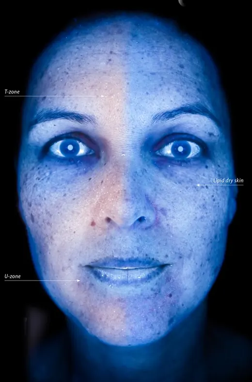 Skin photographed in the Observ 520x Wood’s light mode, with the features the mode reveals marked