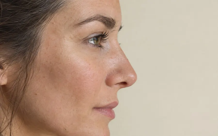 Drooping nasal tip, shown on the face